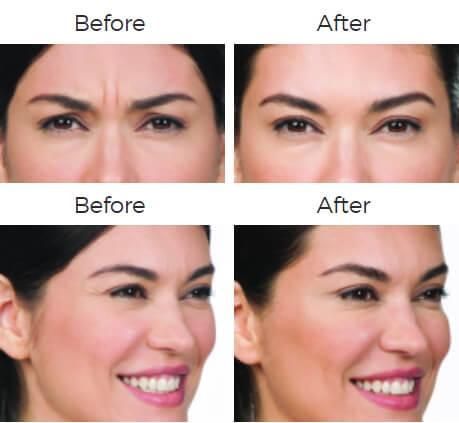 Botox Before & After