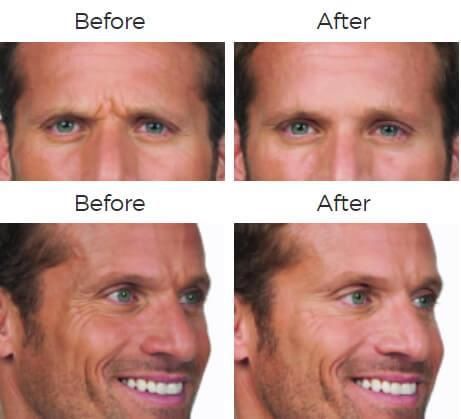 Botox Before & After