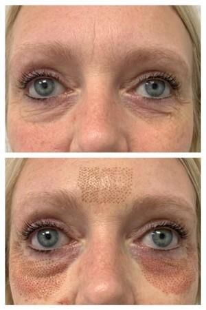 Plasma Pen Before & After