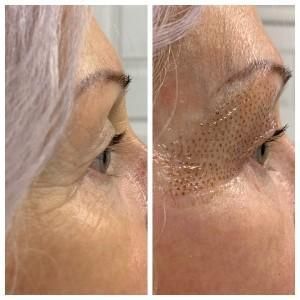 Plasma Pen Before & After