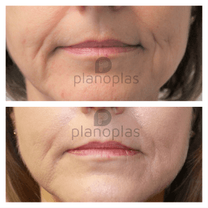 Plasma Pen Before & After