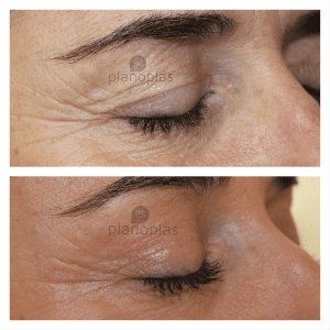 Plasma Pen Before & After