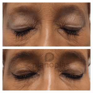 Plasma Pen Before & After