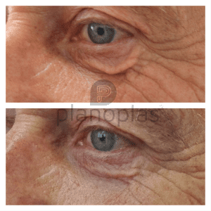 Plasma Pen Before & After