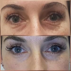 Plasma Pen Before & After