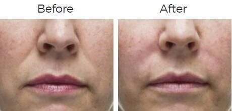 Radiesse Before & After