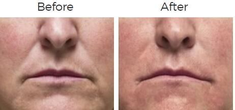 Radiesse Before &#38; After