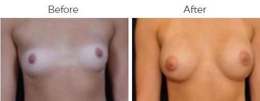 Breast Augmentation Before & After
