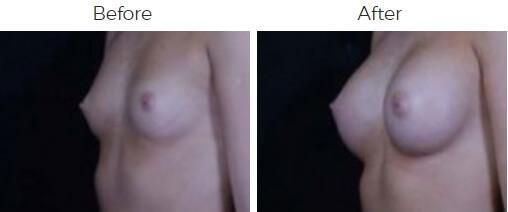 Breast Augmentation Before & After