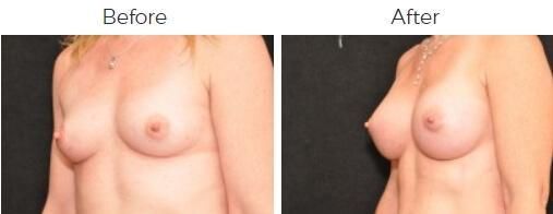 Breast Augmentation Before & After