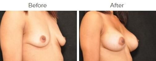 Breast Augmentation Before & After