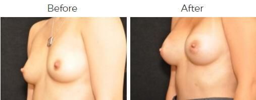Breast Augmentation Before & After