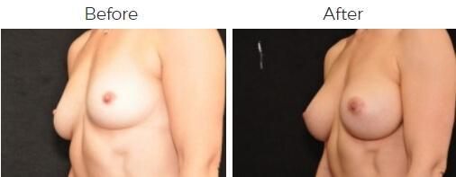 Breast Augmentation Before & After