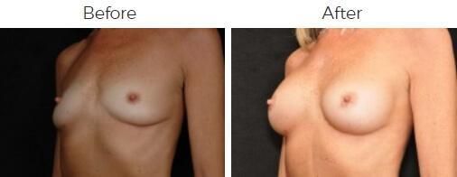 Breast Augmentation Before & After