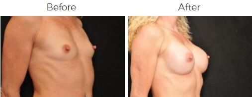 Breast Augmentation Before & After
