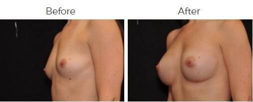 Breast Augmentation Before & After