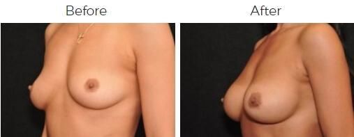 Breast Augmentation Before & After