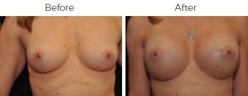 Breast Augmentation Before & After