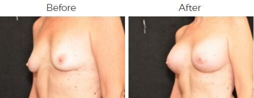 Breast Augmentation Before & After