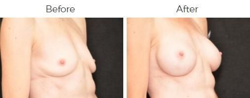 Breast Augmentation Before & After