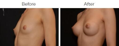 Breast Augmentation Before & After