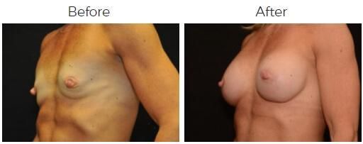 Breast Augmentation Before & After