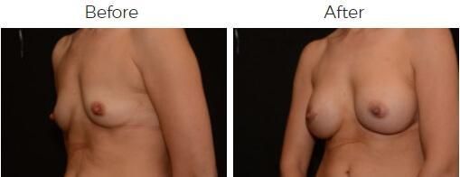 Breast Augmentation Before & After