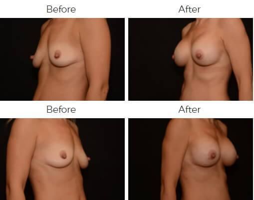 Breast Augmentation Before & After