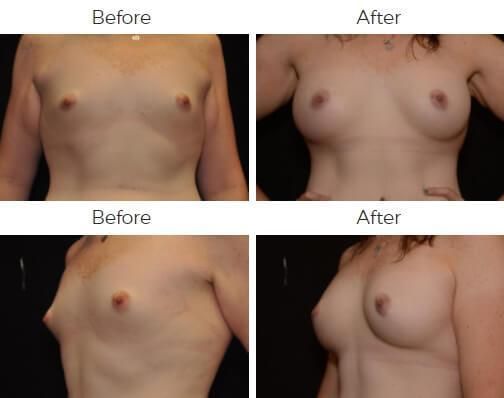 Breast Augmentation Before & After