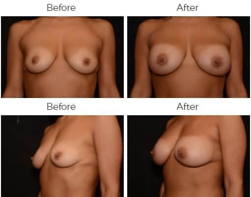 Breast Augmentation Before & After