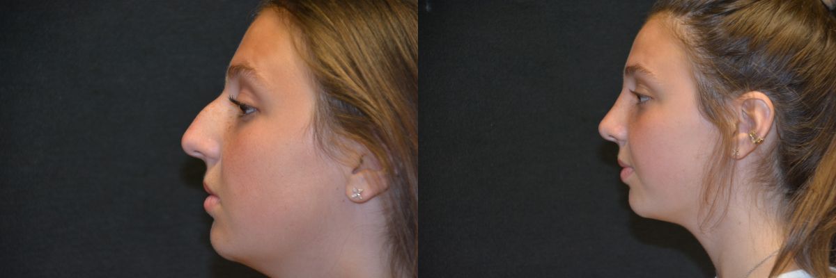 Rhinoplasty Before & After