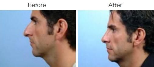 Rhinoplasty Before & After