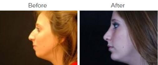 Rhinoplasty Before & After