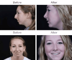 Rhinoplasty Before & After