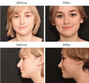Rhinoplasty Before & After