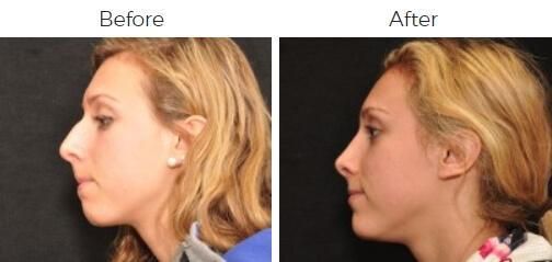 Rhinoplasty Before & After