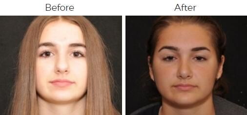 Rhinoplasty Before & After