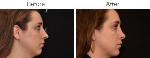 Rhinoplasty Before & After