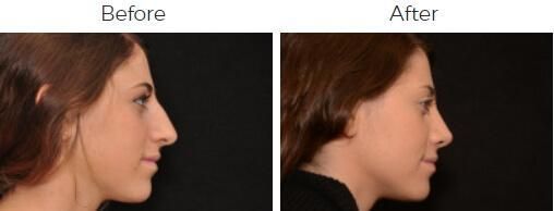 Rhinoplasty Before & After