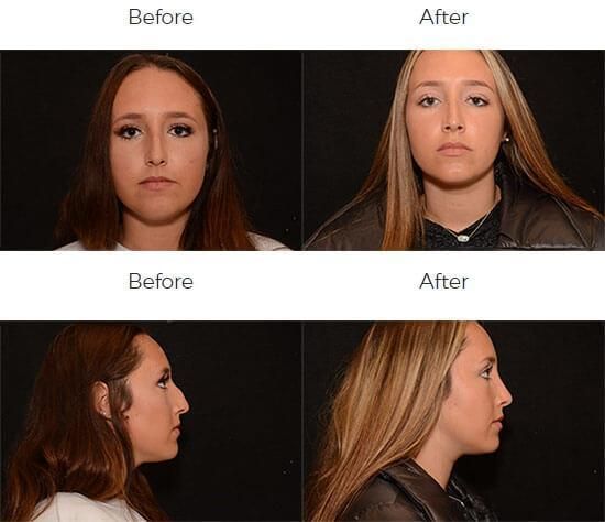 Rhinoplasty Before & After