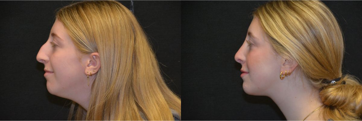 Rhinoplasty Before & After