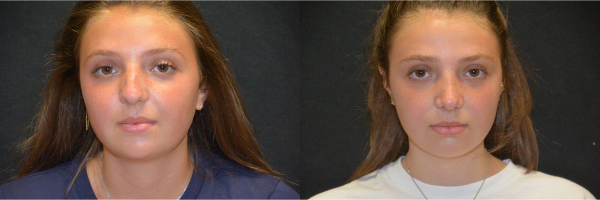 Rhinoplasty Before & After