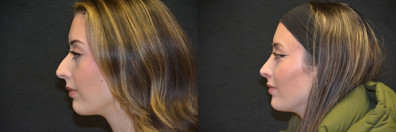 Rhinoplasty Before & After