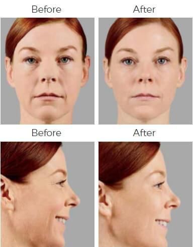 Voluma Before & After