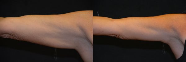Arm Lift Before & After