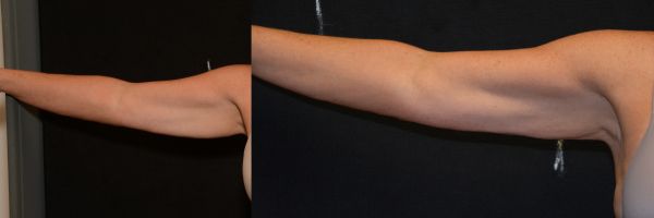 Arm Lift Before & After