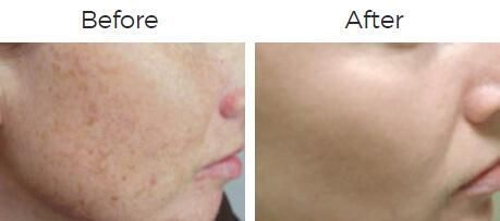 Photofacial Ipl Before & After