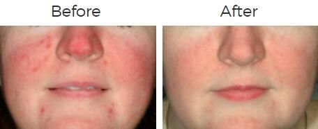 Photofacial Ipl Before & After