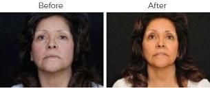 Brow Lift Before & After