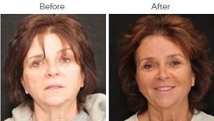 Brow Lift Before & After